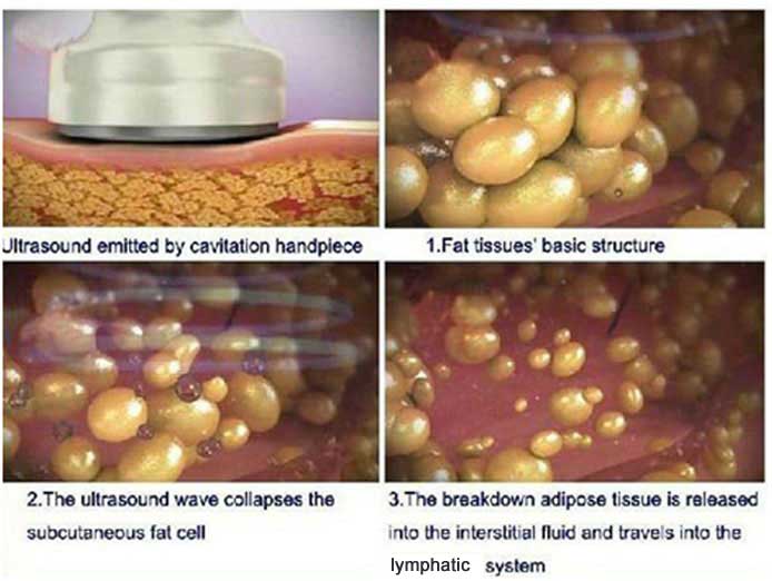 Ultrasonic Fat Cavitation » Non-Surgical Liposuction - Fat